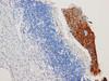 Immunohistochemistry of paraffinembedded Human cervical squamous cell carcinoma with P16 Monoclonal Antibody(Antigen repaired by EDTA).