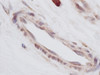This antibody stained formalin-fixed, paraffin-embedded sections of human breast invasive ductal carcinoma. The recommended concentration is 0.5 ug/ml with a two-hour incubation at room temperature. An HRP-labeled polymer detection system was used with a DAB chromogen. Heat induced antigen retrieval with a pH 6.0 Sodium Citrate buffer is recommended. Optimal concentrations and conditions may vary.