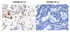 Figure 1 Immunohistochemistry Validation of SARS-CoV-2 (COVID-19) Envelope in COVID-19 Patient Lung 
Immunohistochemical analysis of paraffin-embedded COVID-19 patient lung tissue using anti- SARS-CoV-2 (COVID-19) Envelope antibody (3531, 1 &#956;g/mL) . Tissue was fixed with formaldehyde and blocked with 10% serum for 1 h at RT; antigen retrieval was by heat mediation with a citrate buffer (pH6) . Samples were incubated with primary antibody overnight at 4&#730;C. A goat anti-rabbit IgG H&L (HRP) at 1/250 was used as secondary. Counter stained with Hematoxylin. Strong signal of SARS-COV-2 envelope protein was observed in macrophage of COVID-19 patient lung, but not in non-COVID-19 patient lung.