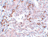 Immunohistochemistry of BCAS1 in human breast carcinoma with BCAS1 antibody at 5 ug/mL.
