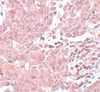 Immunohistochemistry of BCAS3 in human breast carcinoma with BCAS3 antibody at 5 ug/mL.