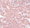 Immunohistochemistry of BCAS4 in human breast carcinoma with BCAS4 antibody at 5 ug/mL.