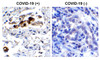 Figure 2 Immunohistochemistry Validation of SARS-CoV-2 (COVID-19) Spike RBD in COVID-19 Patient Lung 
Immunohistochemical analysis of paraffin-embedded COVID-19 patient lung tissue using anti- SARS-CoV-2 (COVID-19) Spike RBD antibody (9087, 0.5 ug/mL) . Tissue was fixed with formaldehyde and blocked with 10% serum for 1 h at RT; antigen retrieval was by heat mediation with a citrate buffer (pH6) . Samples were incubated with primary antibody overnight at 4&#730;C. A goat anti-rabbit IgG H&L (HRP) at 1/250 was used as secondary. Counter stained with Hematoxylin. Strong signal of SARS-COV-2 Spike RBD protein was observed in macrophage of COVID-19 patient lung, but not in non-COVID-19 patient lung.