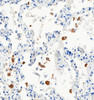 Figure 2 Immunohistochemistry Validation of SARS-CoV-2 (COVID-19) Nucleocapsid in Human Lung Tissue from the COVID-19 Patient 
Immunohistochemical analysis of paraffin-embedded COVID-19 patient lung tissue using anti-SARS-CoV-2 (COVID-19) Nucleocapsid antibody (9099, 0.02 ug/mL) . Tissue was fixed with formaldehyde and blocked with 10% serum for 1 h at RT; antigen retrieval was by heat mediation with a citrate buffer (pH6) . Samples were incubated with primary antibody overnight at 4&#730;C. A goat anti-rabbit IgG H&L (HRP) at 1/250 was used as secondary. Counter stained with Hematoxylin. (Courtesy of Dr. Hallgeir Rui, MCW) (Picture shown in 40X magnification)