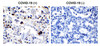 Figure 1 Immunohistochemistry Validation of SARS-CoV-2 (COVID-19) 3L-PRO in COVID-19 Patient Lung 
Immunohistochemical analysis of paraffin-embedded COVID-19 patient lung tissue using anti- SARS-CoV-2 (COVID-19) 3L-PRO (NSP5) antibody (9153, 0.5 &#956;g/mL) . Tissue was fixed with formaldehyde and blocked with 10% serum for 1 h at RT; antigen retrieval was by heat mediation with a citrate buffer (pH6) . Samples were incubated with primary antibody overnight at 4&#730;C. A goat anti-rabbit IgG H&L (HRP) at 1/250 was used as secondary. Counter stained with Hematoxylin. Strong signal of SARS-COV-2 3L-PRO (NSP5) protein was observed in macrophage of COVID-19 patient lung, but not in non-COVID-19 patient lung.