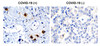 Figure 1 Immunohistochemistry Validation of SARS-CoV-2 (COVID-19) NSP7 in COVID-19 Patient Lung 
Immunohistochemical analysis of paraffin-embedded COVID-19 patient lung tissue using anti- SARS-CoV-2 (COVID-19) NSP7 antibody (9155, 0.5 &#956;g/mL) . Tissue was fixed with formaldehyde and blocked with 10% serum for 1 h at RT; antigen retrieval was by heat mediation with a citrate buffer (pH6) . Samples were incubated with primary antibody overnight at 4&#730;C. A goat anti-rabbit IgG H&L (HRP) at 1/250 was used as secondary. Counter stained with Hematoxylin. Strong signal of SARS-COV-2 NSP7 protein was observed in macrophage of COVID-19 patient lung, but not in non-COVID-19 patient lung.