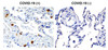 Figure 1 Immunohistochemistry Validation of SARS-CoV-2 (COVID-19) NSP8 in COVID-19 Patient Lung 
Immunohistochemical analysis of paraffin-embedded COVID-19 patient lung tissue using anti- SARS-CoV-2 (COVID-19) NSP8 antibody (9159, 0.5 &#956;g/mL) . Tissue was fixed with formaldehyde and blocked with 10% serum for 1 h at RT; antigen retrieval was by heat mediation with a citrate buffer (pH6) . Samples were incubated with primary antibody overnight at 4&#730;C. A goat anti-rabbit IgG H&L (HRP) at 1/250 was used as secondary. Counter stained with Hematoxylin. Strong signal of SARS-COV-2 NSP8 protein was observed in macrophage of COVID-19 patient lung, but not in non-COVID-19 patient lung.
