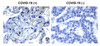 Figure 1 Immunohistochemistry Validation of SARS-CoV-2 (COVID-19) NSP9 in COVID-19 Patient Lung 
Immunohistochemical analysis of paraffin-embedded COVID-19 patient lung tissue using anti- SARS-CoV-2 (COVID-19) NSP9 antibody (9161, 0.5 &#956;g/mL) . Tissue was fixed with formaldehyde and blocked with 10% serum for 1 h at RT; antigen retrieval was by heat mediation with a citrate buffer (pH6) . Samples were incubated with primary antibody overnight at 4&#730;C. A goat anti-rabbit IgG H&L (HRP) at 1/250 was used as secondary. Counter stained with Hematoxylin. Strong signal of SARS-COV-2 NSP9 protein was observed in macrophage of COVID-19 patient lung, but not in non-COVID-19 patient lung.