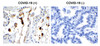 Figure 1 Immunohistochemistry Validation of SARS-CoV-2 (COVID-19) Membrane in COVID-19 Patient Lung 
Immunohistochemical analysis of paraffin-embedded COVID-19 patient lung tissue using anti- SARS-CoV-2 (COVID-19) Membrane antibody (9165, 0.5 &#956;g/mL) . Tissue was fixed with formaldehyde and blocked with 10% serum for 1 h at RT; antigen retrieval was by heat mediation with a citrate buffer (pH6) . Samples were incubated with primary antibody overnight at 4&#730;C. A goat anti-rabbit IgG H&L (HRP) at 1/250 was used as secondary. Counter stained with Hematoxylin. Strong signal of SARS-COV-2 Membrane protein was observed in macrophage of COVID-19 patient lung, but not in non-COVID-19 patient lung.