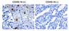 Figure 1 Immunohistochemistry Validation of SARS-CoV-2 (COVID-19) NSP10 in COVID-19 Patient Lung 
Immunohistochemical analysis of paraffin-embedded COVID-19 patient lung tissue using anti- SARS-CoV-2 (COVID-19) NSP10 antibody (9179, 0.5 &#956;g/mL) . Tissue was fixed with formaldehyde and blocked with 10% serum for 1 h at RT; antigen retrieval was by heat mediation with a citrate buffer (pH6) . Samples were incubated with primary antibody overnight at 4&#730;C. A goat anti-rabbit IgG H&L (HRP) at 1/250 was used as secondary. Counter stained with Hematoxylin. Strong signal of SARS-COV-2 NSP10 protein was observed in macrophage of COVID-19 patient lung, but not in non-COVID-19 patient lung.