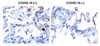 Figure 1 Immunohistochemistry Validation of SARS-CoV-2 (COVID-19) NSP13 in COVID-19 Patient Lung 
Immunohistochemical analysis of paraffin-embedded COVID-19 patient lung tissue using anti- SARS-CoV-2 (COVID-19) NSP13 antibody (9181, 0.5 &#956;g/mL) . Tissue was fixed with formaldehyde and blocked with 10% serum for 1 h at RT; antigen retrieval was by heat mediation with a citrate buffer (pH6) . Samples were incubated with primary antibody overnight at 4&#730;C. A goat anti-rabbit IgG H&L (HRP) at 1/250 was used as secondary. Counter stained with Hematoxylin. Strong signal of SARS-COV-2 NSP13 protein was observed in macrophage of COVID-19 patient lung, but not in non-COVID-19 patient lung.