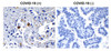 Figure 1 Immunohistochemistry Validation of SARS-CoV-2 (COVID-19) NSP13 in COVID-19 Patient Lung 
Immunohistochemical analysis of paraffin-embedded COVID-19 patient lung tissue using anti- SARS-CoV-2 (COVID-19) NSP13 antibody (9183, 0.5 &#956;g/mL) . Tissue was fixed with formaldehyde and blocked with 10% serum for 1 h at RT; antigen retrieval was by heat mediation with a citrate buffer (pH6) . Samples were incubated with primary antibody overnight at 4&#730;C. A goat anti-rabbit IgG H&L (HRP) at 1/250 was used as secondary. Counter stained with Hematoxylin. Strong signal of SARS-COV-2 NSP13 protein was observed in macrophage of COVID-19 patient lung, but not in non-COVID-19 patient lung.