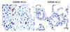 Figure 1 Immunohistochemistry Validation of SARS-CoV-2 (COVID-19) NSP14 in COVID-19 Patient Lung 
Immunohistochemical analysis of paraffin-embedded COVID-19 patient lung tissue using anti- SARS-CoV-2 (COVID-19) NSP14 antibody (9185, 0.5 &#956;g/mL) . Tissue was fixed with formaldehyde and blocked with 10% serum for 1 h at RT; antigen retrieval was by heat mediation with a citrate buffer (pH6) . Samples were incubated with primary antibody overnight at 4&#730;C. A goat anti-rabbit IgG H&L (HRP) at 1/250 was used as secondary. Counter stained with Hematoxylin. Strong signal of SARS-COV-2 NSP14 protein was observed in macrophage of COVID-19 patient lung, but not in non-COVID-19 patient lung.