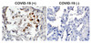 Figure 1 Immunohistochemistry Validation of SARS-CoV-2 (COVID-19) Spike in COVID-19 Patient Lung 
Immunohistochemical analysis of paraffin-embedded COVID-19 patient lung tissue using anti- SARS-CoV-2 (COVID-19) spike antibody (3525-biotin, 2 &#956;g/mL) . Tissue was fixed with formaldehyde and blocked with 10% serum for 1 h at RT; antigen retrieval was by heat mediation with a citrate buffer (pH6) . Samples were incubated with primary antibody overnight at 4&#730;C, following by streptavidin-HRP conjugate at 20 &#956;g/mL. Counter stained with Hematoxylin. Strong signal of SARS-COV-2 spike protein was observed in macrophages of COVID-19 patient lung, but not in non-COVID-19 patient lung.