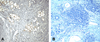 (A) Immunohistochemistry of PD-1 in human breast cancer tissue with PD-1 [4C7] antibody at 10 ug/mL. (B) Immunohistochemistry in human breast cancer tissue with control mouse IgG staining at 10 ug/mL.