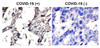 Figure 2 Immunohistochemistry Validation of SARS-CoV-2 (COVID-19) Envelope Protein in COVID-19 Patient Lung 
Immunohistochemical analysis of paraffin-embedded COVID-19 patient lung tissue using anti- SARS-CoV-2 (COVID-19) envelope antibody (3531-HRP, 2 ug/mL) . Tissue was fixed with formaldehyde and blocked with 10% serum for 1 h at RT; antigen retrieval was by heat mediation with a citrate buffer (pH6) . Samples were incubated with primary antibody overnight at 4&#730;C, following by streptavidin-HRP conjugate at 20 ug/mL. Counter stained with Hematoxylin. Strong signal of SARS-COV-2 envelope protein was observed in macrophages of COVID-19 patient lung, but not in non-COVID-19 patient lung.