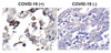 Figure 1 Immunohistochemistry Validation of SARS-CoV-2 (COVID-19) Envelope Protein in COVID-19 Patient Lung 
Immunohistochemical analysis of paraffin-embedded COVID-19 patient lung tissue using anti- SARS-CoV-2 (COVID-19) envelope antibody (3531-HRP, 2 &#956;g/mL) . Tissue was fixed with formaldehyde and blocked with 10% serum for 1 h at RT; antigen retrieval was by heat mediation with a citrate buffer (pH6) . Samples were incubated with primary antibody overnight at 4&#730;C. Counter stained with Hematoxylin. Strong signal of SARS-COV-2 envelope protein was observed in macrophages of COVID-19 patient lung, but not in non-COVID-19 patient lung.