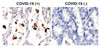 Figure 1 Immunohistochemistry Validation of SARS-CoV-2 (COVID-19) Nucleocapsid Protein in COVID-19 Patient Lung 
Immunohistochemical analysis of paraffin-embedded COVID-19 patient lung tissue using anti- SARS-CoV-2 (COVID-19) nucleocapsid antibody (9099-HRP, 2 &#956;g/mL) . Tissue was fixed with formaldehyde and blocked with 10% serum for 1 h at RT; antigen retrieval was by heat mediation with a citrate buffer (pH6) . Samples were incubated with primary antibody overnight at 4&#730;C, following by streptavidin-HRP conjugate at 20 &#956;g/mL. Counter stained with Hematoxylin. Strong signal of SARS-COV-2 nucleocapsid protein was observed in macrophages of COVID-19 patient lung, but not in non-COVID-19 patient lung.