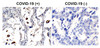 Figure 1 Immunohistochemistry Validation of SARS-CoV-2 (COVID-19) Nucleocapsid Protein in COVID-19 Patient Lung 
Immunohistochemical analysis of paraffin-embedded COVID-19 patient lung tissue using anti- SARS-CoV-2 (COVID-19) nucleocapsid antibody (9099-HRP, 2 &#956;g/mL) . Tissue was fixed with formaldehyde and blocked with 10% serum for 1 h at RT; antigen retrieval was by heat mediation with a citrate buffer (pH6) . Samples were incubated with primary antibody overnight at 4&#730;C. Counter stained with Hematoxylin. Strong signal of SARS-COV-2 nucleocapsid protein was observed in macrophages of COVID-19 patient lung, but not in non-COVID-19 patient lung.