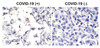Figure 2 Immunohistochemistry Validation of SARS-CoV-2 (COVID-19) Membrane Protein in COVID-19 Patient Lung 
Immunohistochemical analysis of paraffin-embedded COVID-19 patient lung tissue using anti- SARS-CoV-2 (COVID-19) membrane antibody (9157-HRP, 2 ug/mL) . Tissue was fixed with formaldehyde and blocked with 10% serum for 1 h at RT; antigen retrieval was by heat mediation with a citrate buffer (pH6) . Samples were incubated with primary antibody overnight at 4&#730;C, following by streptavidin-HRP conjugate at 20 ug/mL. Counter stained with Hematoxylin. SARS-COV-2 membrane protein was observed in macrophages of COVID-19 patient lung, but not in non-COVID-19 patient lung.