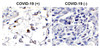 Figure 1 Immunohistochemistry Validation of SARS-CoV-2 (COVID-19) Membrane Protein in COVID-19 Patient Lung 
Immunohistochemical analysis of paraffin-embedded COVID-19 patient lung tissue using anti- SARS-CoV-2 (COVID-19) membrane antibody (9099-HRP, 2 &#956;g/mL) . Tissue was fixed with formaldehyde and blocked with 10% serum for 1 h at RT; antigen retrieval was by heat mediation with a citrate buffer (pH6) . Samples were incubated with primary antibody overnight at 4&#730;C. Counter stained with Hematoxylin. SARS-COV-2 membrane protein was observed in macrophages of COVID-19 patient lung, but not in non-COVID-19 patient lung.