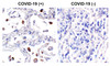 Figure 1 Immunohistochemistry Validation of SARS-CoV-2 (COVID-19) Spike in COVID-19 Patient Lung Immunohistochemical analysis of paraffin-embedded COVID-19 patient lung tissue using anti-SARS-CoV-2 (COVID-19) Spike S2 antibody (PM-9428, 0.5 &#956;g/mL) . Tissue was fixed with formaldehyde and blocked with 10% serum for 1 h at RT; antigen retrieval was by heat mediation with a citrate buffer (pH6) . Samples were incubated with primary antibody overnight at 4&#730;. A goat anti-mouse IgG H&L (HRP) at 1/250 was used as secondary. Counter stained with Hematoxylin. Strong spike protein signal was observed in macrophages of COVID-19 patient lung, but not in non-COVID-19 patient lung.