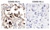 <strong>Figure 1 Immunohistochemistry Validation of SARS-CoV-2 (COVID-19) Nucleocapsid in COVID-19 Patient Lung</strong><br> 
Immunohistochemical analysis of paraffin-embedded COVID-19 patient lung tissue using anti- SARS-CoV-2 (COVID-19) Nucleocapsid antibody (10-352, 1 ug/mL) . Tissue was fixed with formaldehyde and blocked with 10% serum for 1 h at RT; antigen retrieval was by heat mediation with a citrate buffer (pH6) . Samples were incubated with primary antibody overnight at 4&#730;C. A goat anti-rabbit IgG H&L (HRP) at 1/250 was used as secondary. Counter stained with Hematoxylin. Strong signal of SARS-COV-2 Nucleocapsid protein was observed in the macrophages of COVID-19 patient lung, but not in non-COVID-19 patient lung.