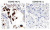 <strong>Figure 1 Immunohistochemistry Validation of SARS-CoV-2 (COVID-19) Nucleocapsid in COVID-19 Patient Lung</strong><br> 
Immunohistochemical analysis of paraffin-embedded COVID-19 patient lung tissue using anti- SARS-CoV-2 (COVID-19) Nucleocapsid antibody (10-353, 1 ug/mL) . Tissue was fixed with formaldehyde and blocked with 10% serum for 1 h at RT; antigen retrieval was by heat mediation with a citrate buffer (pH6) . Samples were incubated with primary antibody overnight at 4&#730;C. A goat anti-rabbit IgG H&L (HRP) at 1/250 was used as secondary. Counter stained with Hematoxylin. Strong signal of SARS-COV-2 Nucleocapsid protein was observed in the macrophages of COVID-19 patient lung, but not in non-COVID-19 patient lung.