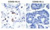 <strong>Figure 1 Immunohistochemistry Validation of SARS-CoV-2 (COVID-19) Nucleocapsid in COVID-19 Patient Lung</strong><br> 
Immunohistochemical analysis of paraffin-embedded COVID-19 patient lung tissue using anti- SARS-CoV-2 (COVID-19) Nucleocapsid antibody (10-750, 1 ng/mL) . Tissue was fixed with formaldehyde and blocked with 10% serum for 1 h at RT; antigen retrieval was by heat mediation with a citrate buffer (pH6) . Samples were incubated with primary antibody overnight at 4&#730;C. A goat anti-rabbit IgG H&L (HRP) at 1/250 was used as secondary. Counter stained with Hematoxylin. Strong signal of SARS-COV-2 Nucleocapsid protein was observed in the macrophages of COVID-19 patient lung, but not in non-COVID-19 patient lung.