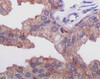 Immunohistochemical analysis of paraffin - embedded human prostate adenocarcinoma tissue showing cytoplasma location using AMACR antibody with DAB staining.