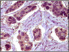 Immunohistochemical analysis of paraffin - embedded liver carcinoma showing cytoplasmic localization using BCL10 antibody with DAB staining.