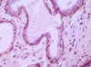 Immunohistochemical analysis of paraffin - embedded human breast ductal myoepithelium showing cytoplasmic localization using CD10 antibody with DAB staining.