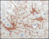 Immunohistochemical analysis of paraffin - embedded human cerebrum tumor tissue (top) and human lymphocyte of thymus (bottom) showing cytoplasma location using FES antibody with DAB staining.