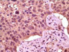 Immunohistochemical analysis of paraffin - embedded human lung carcinoma showing cytoplasmic localization using GSK3 alpha antibody with DAB staining.