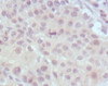 Immunohistochemical analysis of paraffin - embedded human lung cancer (top) and esophagus cancer (bottom) showing nuclear weak staining with DAB staining using MLL antibody.
