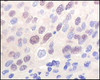 Immunohistochemical analysis of paraffin - embedded human rectum adenocarcinoma (top) and breast infiltrating carcinoma (bottom) showing nuclear location using Hmof / MYST1 antibody with DAB staining.