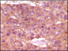 Immunohistochemical analysis of paraffin - embedded human skin carcinoma (top) and breast carcinoma (bottom) showing cytoplasmic and membrane location using SRA antibody with DAB staining.