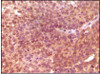 Immunohistochemical analysis of paraffin - embedded human bladder carcinoma (top) and breast carcinoma (bottom) showing nuclear and cytoplasmic location using SRA antibody with DAB staining.