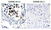 <strong>Figure 1 Immunohistochemistry Validation of SARS-CoV-2 (COVID-19) Nucleocapsid in COVID-19 Patient Lung</strong><br> 
Immunohistochemical analysis of paraffin-embedded COVID-19 patient lung tissue using anti- SARS-CoV-2 (COVID-19) Nucleocapsid antibody (35-719, 1 ug/mL) . Tissue was fixed with formaldehyde and blocked with 10% serum for 1 h at RT; antigen retrieval was by heat mediation with a citrate buffer (pH6) . Samples were incubated with primary antibody overnight at 4&#730;C. A goat anti-rabbit IgG H&L (HRP) at 1/250 was used as secondary. Counter stained with Hematoxylin. Strong signal of SARS-COV-2 Nucleocapsid protein was observed in the macrophages of COVID-19 patient lung, but not in non-COVID-19 patient lung