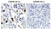 <strong>Figure 1 Immunohistochemistry Validation of SARS-CoV-2 (COVID-19) Nucleocapsid in COVID-19 Patient Lung</strong><br> 
Immunohistochemical analysis of paraffin-embedded COVID-19 patient lung tissue using anti- SARS-CoV-2 (COVID-19) Nucleocapsid antibody (35-720, 1 ug/mL) . Tissue was fixed with formaldehyde and blocked with 10% serum for 1 h at RT; antigen retrieval was by heat mediation with a citrate buffer (pH6) . Samples were incubated with primary antibody overnight at 4&#730;C. A goat anti-rabbit IgG H&L (HRP) at 1/250 was used as secondary. Counter stained with Hematoxylin. Strong signal of SARS-COV-2 Nucleocapsid protein was observed in the macrophages of COVID-19 patient lung, but not in non-COVID-19 patient lung.