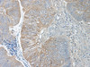 This antibody stained formalin-fixed, paraffin-embedded sections of human colon/rectum adenocarcinoma. The recommended concentration is 0.25 mg/ml with an overnight incubation at 4&#730;C. An HRP-labeled polymer detection system was used with a DAB chromogen. Proteinase K antigen retrieval is recommended. Optimal concentrations and conditions may vary.