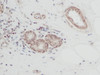 This antibody stained formalin-fixed, paraffin-embedded sections of human breast invasive ductal carcinoma. The recommended concentration is 0.25 ug/ml with an overnight incubation at 4&#730;C. An HRP-labeled polymer detection system was used with a DAB chromogen. Heat induced antigen retrieval with a pH 6.0 sodium citrate buffer is recommended. Optimal concentrations and conditions may vary.