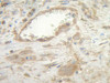 This antibody stained formalin-fixed, paraffin-embedded sections of human angiosarcoma. The recommended concentration is 0.75 ug/mL - 2.5 ug/mL with an overnight incubation at 4&#730;C. An HRP-labeled polymer detection system was used with a AB chromogen. Heat induced antigen retrieval with a pH 6.0 sodium citrate buffer is recommended. Optimal concentrations and conditions may vary.