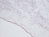 This antibody stained formalin-fixed, paraffin-embedded sections of human breast invasive ductal carcinoma. The recommended concentration is 0.25 ug/ml with an overnight incubation at 4&#730;C. An HRP-labeled polymer detection system was used with a DAB chromogen. Optimal results for these conditions were achieved without antigen retrieval. Optimal concentrations and conditions may vary.