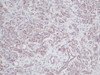 This antibody stained formalin-fixed, paraffin-embedded sections of human breast invasive ductal carcinoma. The recommended concentration is 0.125ug/ml-0.250ug/ml with an overnight incubation at 4&#730;C. An HRP-labeled polymer detection system was used with a DAB chromogen. Heat induced antigen retrieval with a pH 6.0 sodium citrate buffer is recommended. Optimal concentrations and conditions may vary.