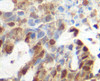 This antibody stained formalin-fixed, paraffin-embedded sections of human breast invasive ductal carcinoma. The recommended concentrations are 15.0-20.0 ug/ml overnight at 4˚C. An HRP-labeled polymer detection system was used with DAB Chromogen. Heat induced antigen retrieval with a pH 6.0 sodium citrate buffer is recommended. Optimal concentrations and conditions may vary. Tissue samples were provided by the Cooperative Human Tissue Network, which is funded by the National Cancer Institute.