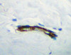 This antibody stained formalin-fixed, paraffin-embedded sections of human breast invasive ductal carcinoma. The recommended concentrations are 0.25-0.50 ug/ml overnight at 4˚C. An HRP-labeled polymer detection system was used with DAB chromogen. Heat induced antigen retrieval was performed with a pH 6.0 Sodium Citrate buffer. Optimal concentrations and conditions may vary. Tissue samples were provided by the Cooperative Human Tissue Network which is funded by the National Cancer Institute.