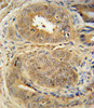 Mdm2 Antibody immunohistochemistry analysis in formalin fixed and paraffin embedded human prostate carcinoma followed by peroxidase conjugation of the secondary antibody and DAB staining.