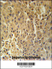 DHB13 Antibody immunohistochemistry analysis in formalin fixed and paraffin embedded human hepatocarcinoma followed by peroxidase conjugation of the secondary antibody and DAB staining.