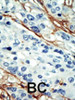 Formalin-fixed and paraffin-embedded human cancer tissue reacted with the primary antibody, which was peroxidase-conjugated to the secondary antibody, followed by DAB staining. BC = breast carcinoma; HC = hepatocarcinoma.